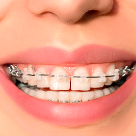 Tratamientos de ortodoncia