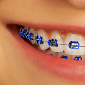 Tratamientos de ortodoncia para adultos